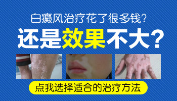 白癜風處在發展期好治療嗎，用什么方法