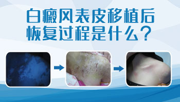 7個月孩子胸部圓形白斑治好后還會復發嗎，如何治療