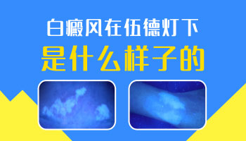 兒童鼻子長白癜風擦他克莫司能治好嗎