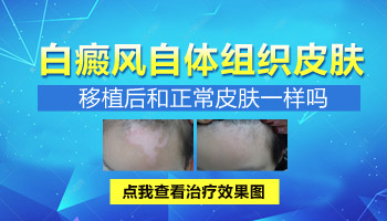 腹部白癜風有拳頭大照308激光費用多少