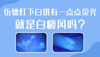 手上有白癜風照308激光是怎么收費的