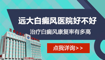 處在發展期的白癜風在變大該怎么辦