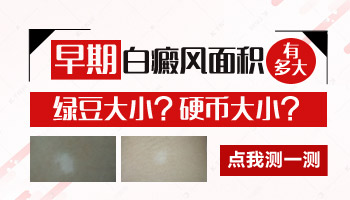 4個月孩子手上有塊白斑會不會是白癜風