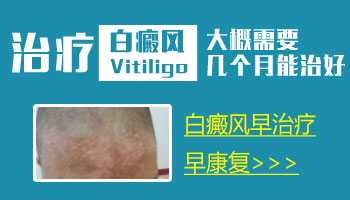 腋下白斑有巴掌大照一次308激光大概多少錢