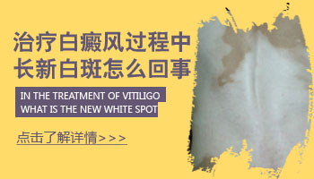 4個月孩子后背有塊白斑怎么檢查是不是白癜風