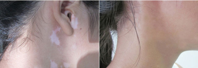 臉上的白斑治好了，終于擺脫剩女行列