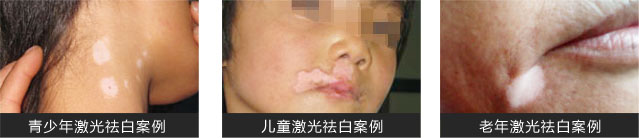 青少年激光祛白案例;兒童激光祛白案例;老人激光祛白案例