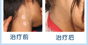 臉部眼角白癜風康復案例