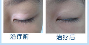 腋下周圍白癜風康復案例