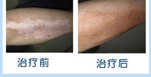 白癜風康復案例