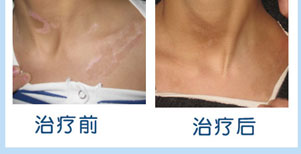 兒童面部白癜風康復案例