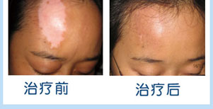 背部白癜風康復案例