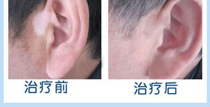 眼角白癜風康復案例