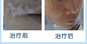 全身白癜風康復案例