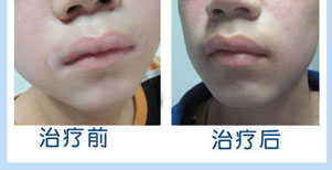 雙臂白癜風康復案例